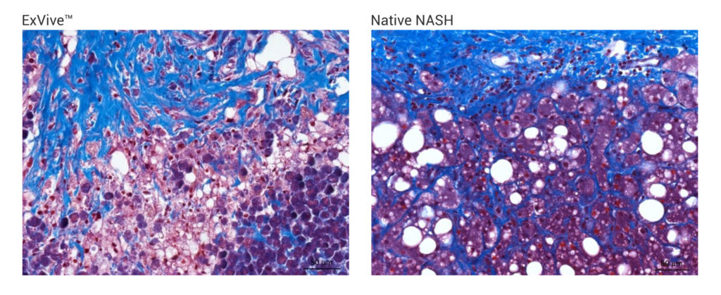 Disease Model ExVive Liver Tissue vs Native NASH Tissue